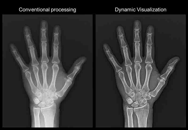 digital xray - conventional processing vs dynamic visualization in panvel & Kharghar navi mumbai